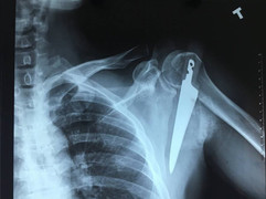 Người đàn ông bị dao dài 20cm đâm vào vai do vô tình vấp ngã trong bếp