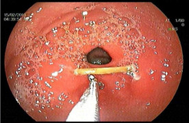 Ngậm tăm khi ngủ, vô tình nuốt luôn vào bụng