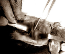 Cứu sống nam thanh niên bị đâm vào cổ, mất máu nặng