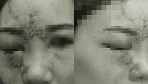 Tiêm filler làm đầy mũi, cô gái trẻ 27 tuổi mù mắt