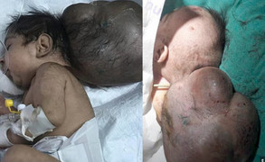 Bé trai '2 đầu' bị chôn sống, người đào huyệt nghe thấy tiếng khóc nên tới cứu