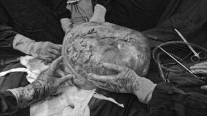 Bà lão 78 tuổi 'nuôi' khối u khổng lồ 30 kg trong nhiều năm