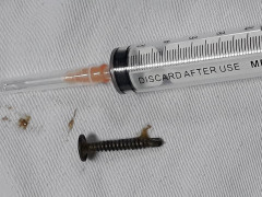 Đinh vít 3cm nằm trong dạ dày bé trai 5 tuổi