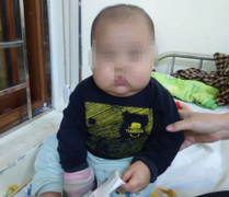 Gia đình tự mua thuốc điều trị tại nhà, bé trai suy thượng thận, phù mặt