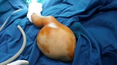 Hơn 3 giờ căng thẳng cắt bỏ khối u khổng lồ cho bé trai 20 tháng tuổi