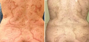 Cơ thể phát ban bất thường, coi chừng mắc bệnh ung thư