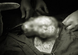 Phẫu thuật cắt khối u buồng trứng 4kg cho cụ bà 90 tuổi