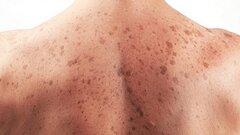 Làm việc lâu dưới trời nắng nóng kéo dài, cẩn thận ung thư da