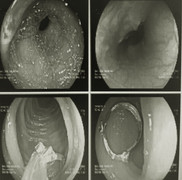 Bé gái 12 tháng tuổi giật hoa tai của bạn nuốt vào bụng