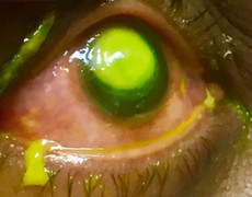 Đeo kính áp tròng ngủ qua đêm, người phụ nữ bị vi khuẩn ăn mòn giác mạc