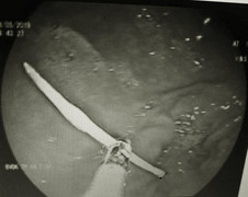 Chiếc xương cá ‘đi lạc’ trong bụng người đàn ông 30 tuổi