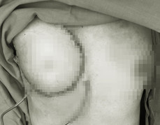 Bác sĩ dùng da phần bụng để tái tạo ngực cho bệnh nhân