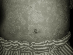 Dùng thuốc Đông y không rõ nguồn gốc trị vảy nến, người đàn ông bị ung thư da