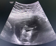 Cô gái trẻ ở Tuyên Quang mang song thai dính liền, chung một quả tim