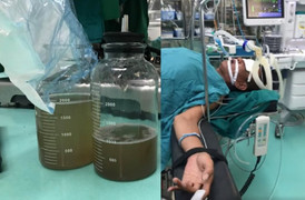 Hy hữu: Hút dầu chạy máy bằng miệng, người đàn ông sặc suýt chết