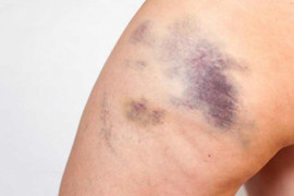 Những nguyên nhân phổ biến gây các vết bầm tím trên cơ thể