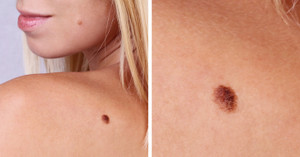 Những dấu hiệu khiến bạn lầm tưởng bản thân đang bị ung thư