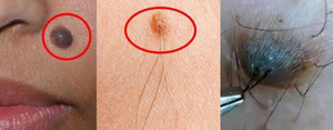 Nốt ruồi ở vị trí nào cảnh báo bệnh ung thư?