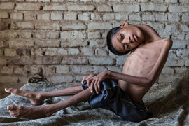 Cậu bé 'đầu không thể dựng thẳng', nhìn thế giới lộn ngược suốt 13 năm