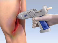 Súng bắn keo sinh học chữa lành vết thương