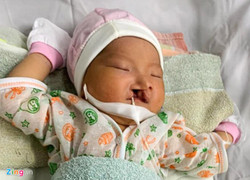 Mẹ bỏ rơi bé sơ sinh bị sứt môi vừa chào đời