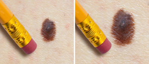 Những kiểu nốt ruồi tố cáo bạn đang bị bệnh, cần đi khám sớm