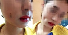 Ham mê phẫu thuật tạo má lúm đồng tiền 'hợp phong thủy', cô gái trẻ bị biến chứng nặng