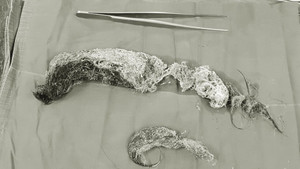 Bé gái 5 tuổi ở Quảng Ninh nuốt cả tóc, bông gòn vào bụng