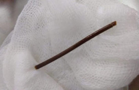 Cụ bà 72 tuổi thủng dạ dày do thói quen ngậm tăm sau khi ăn