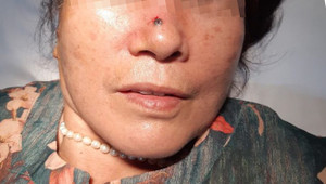 Nốt ruồi 2 năm trên mũi lại ‘hóa’ ung thư da nguy hiểm