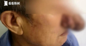 Nghiện rượu suốt 10 năm, mũi cụ ông dài ra như phù thủy