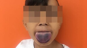 Lưỡi mắc kẹt trong cổ chai, bé trai 7 tuổi nhập viện