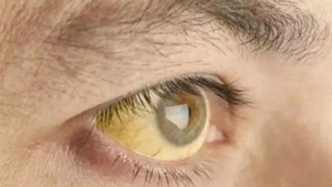 Có 4 biểu hiện này trên khuôn mặt, bạn cần đến bệnh viện ngay