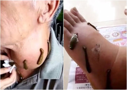 Có nên dùng đỉa chữa bệnh?