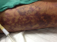 Người bán thịt lợn suýt chết do nhiễm liên cầu khuẩn