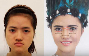 Cô gái Nam Định 'lột xác' ngoạn mục sau phẫu thuật