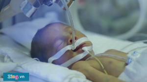 Điều chưa biết về những em bé sinh non