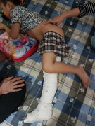 Học sinh lớp 2 gãy đôi xương đùi khi chơi trong sân trường: Phụ huynh đặt nghi vấn