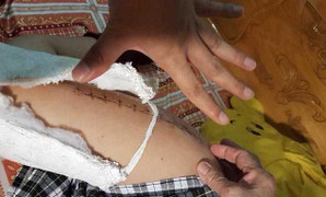 Học sinh lớp 2 bị gãy chân trong sân trường: Bộ trưởng GD-ĐT yêu cầu sớm kết luận