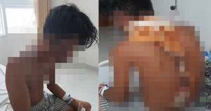 Điều tra vụ nam thanh niên bị chị gái dội nước sôi lên đầu