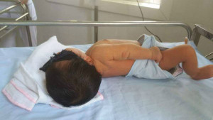 Em bé 8 ngày tuổi phải thay máu hoàn toàn do bị vàng da