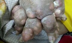 Bàn chân biến dạng to như chân gấu vì bệnh gout khiến ai cũng phải kinh hãi