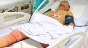 Nhân viên y tế tự chặt cụt chân mắc chứng bệnh hiếm gặp: Vẫn có nguy cơ tái phát