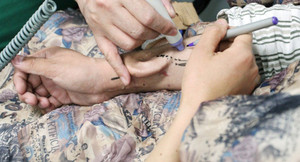 Lần đầu ghép thành công tai 'nuôi' từ tay người bệnh