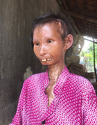 Người phụ nữ xinh đẹp mắc bệnh lạ 'hóa' bà lão nặng 24 kg