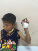 Thương tâm bé trai bị cành cây đâm xuyên qua cổ khi đang chơi đùa