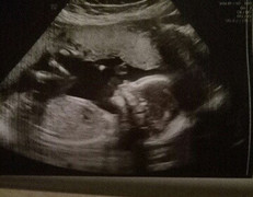 Chuyện lạ: Người phụ nữ có 2 âm đạo, 2 tử cung vẫn mang thai