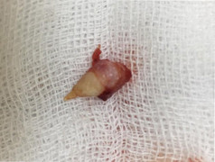 Chuyện lạ: Răng mọc trong mũi của bé gái 4 tuổi ở Hà Nội