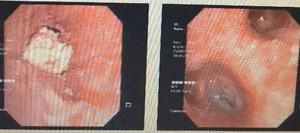 Cụ ông suýt chết vì sặc mề hột vịt lộn