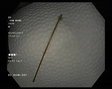 Suýt thủng dạ dày do... tăm lỡ rơi vào bụng